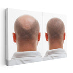 Yatay Kanvas Tablo Ense Bölgesi Saç Yenilenmesi Saç Ekim Uzmanı Tablosu Ev Ofis Duvar Dekoru