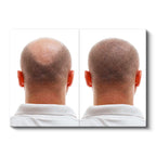 Yatay Kanvas Tablo Ense Bölgesi Saç Yenilenmesi Saç Ekim Uzmanı Tablosu Ev Ofis Duvar Dekoru