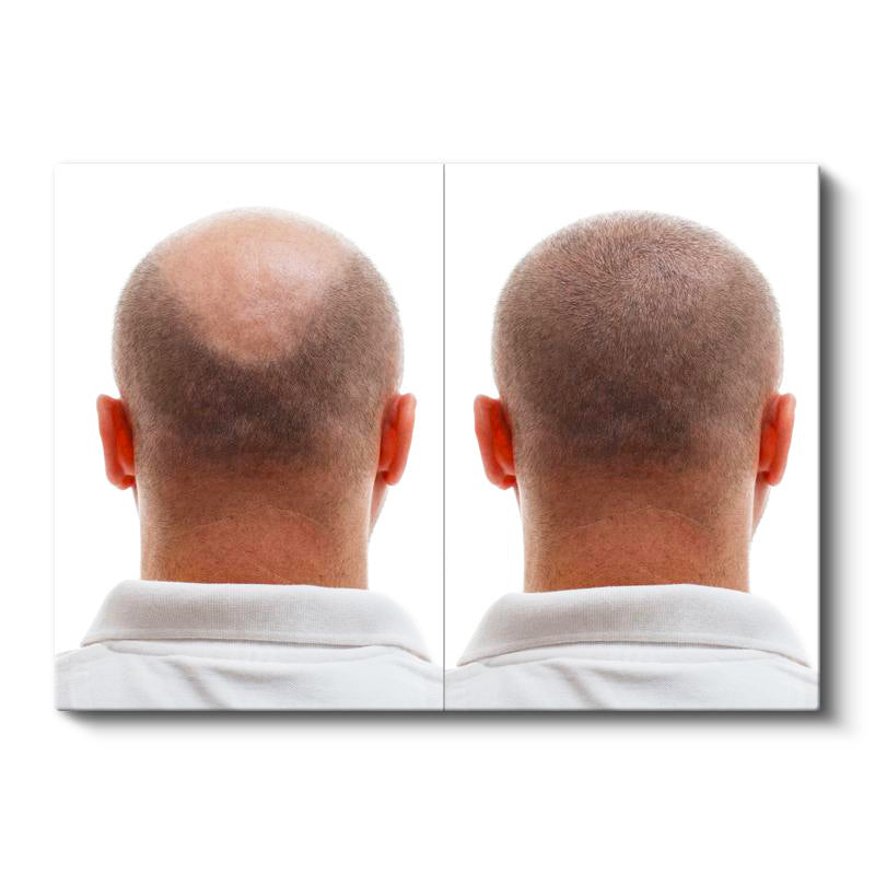 Yatay Kanvas Tablo Ense Bölgesi Saç Yenilenmesi Saç Ekim Uzmanı Tablosu Ev Ofis Duvar Dekoru