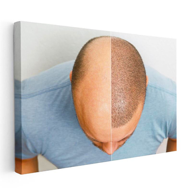 Yatay Kanvas Tablo Tepe Bölgesi Saçlanma Farkı Saç Ekim Uzmanı Tablosu Ev Ofis Duvar Dekoru