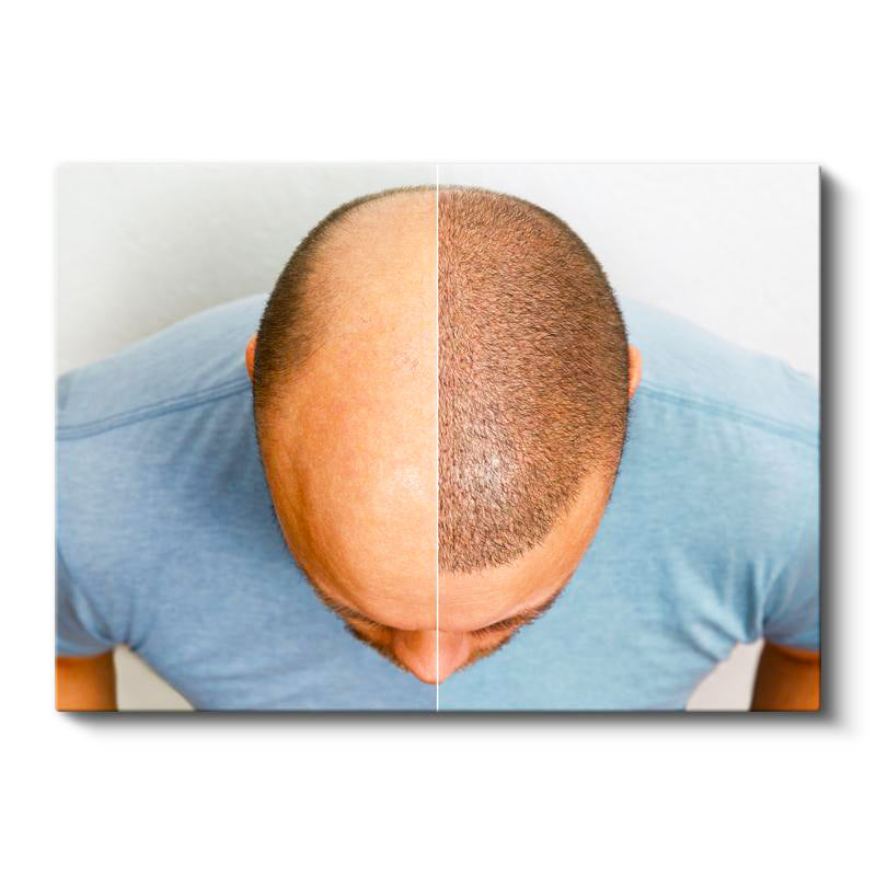Yatay Kanvas Tablo Tepe Bölgesi Saçlanma Farkı Saç Ekim Uzmanı Tablosu Ev Ofis Duvar Dekoru