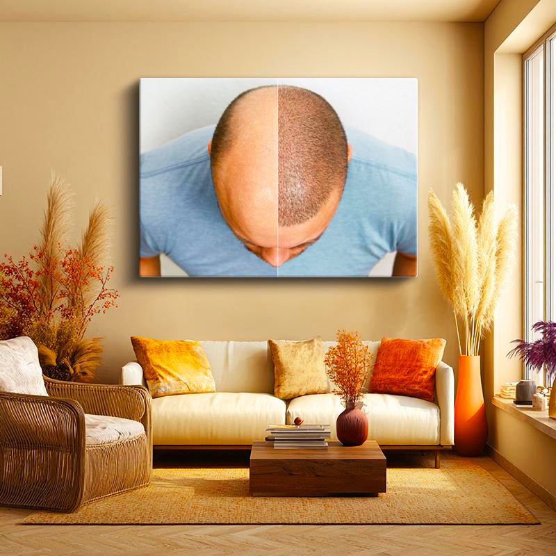 Yatay Kanvas Tablo Tepe Bölgesi Saçlanma Farkı Saç Ekim Uzmanı Tablosu Ev Ofis Duvar Dekoru
