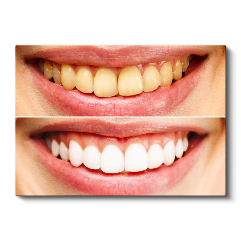 Yatay Kanvas Tablo Diş Beyazlatma İşlemi Öncesi Sonrası Diş Hekimi Tablosu Ev Ofis Duvar Dekoru