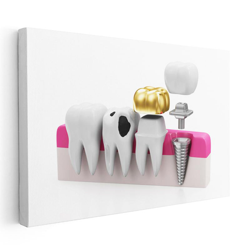 Yatay Kanvas Tablo Altın Kaplama Ve İmplant Diş Diş Hekimi Tablosu Ev Ofis Duvar Dekoru
