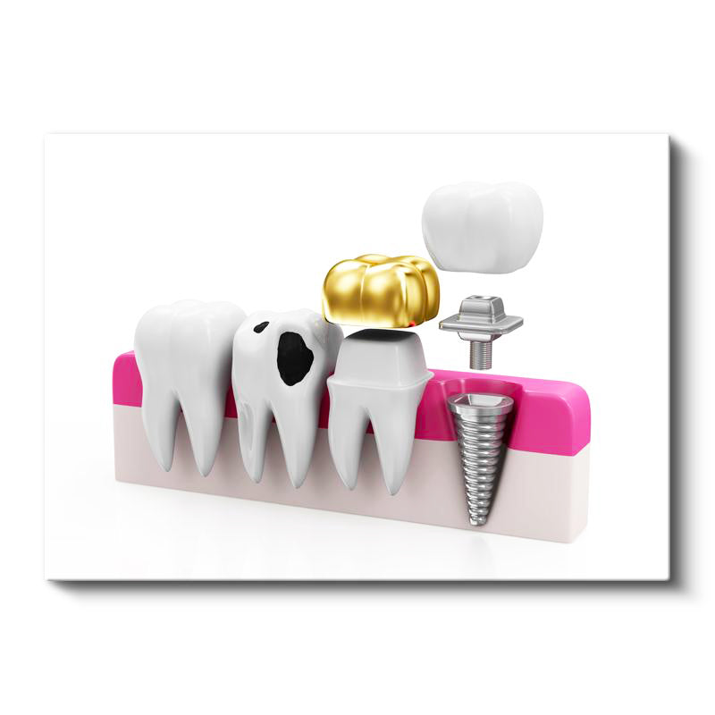 Yatay Kanvas Tablo Altın Kaplama Ve İmplant Diş Diş Hekimi Tablosu Ev Ofis Duvar Dekoru