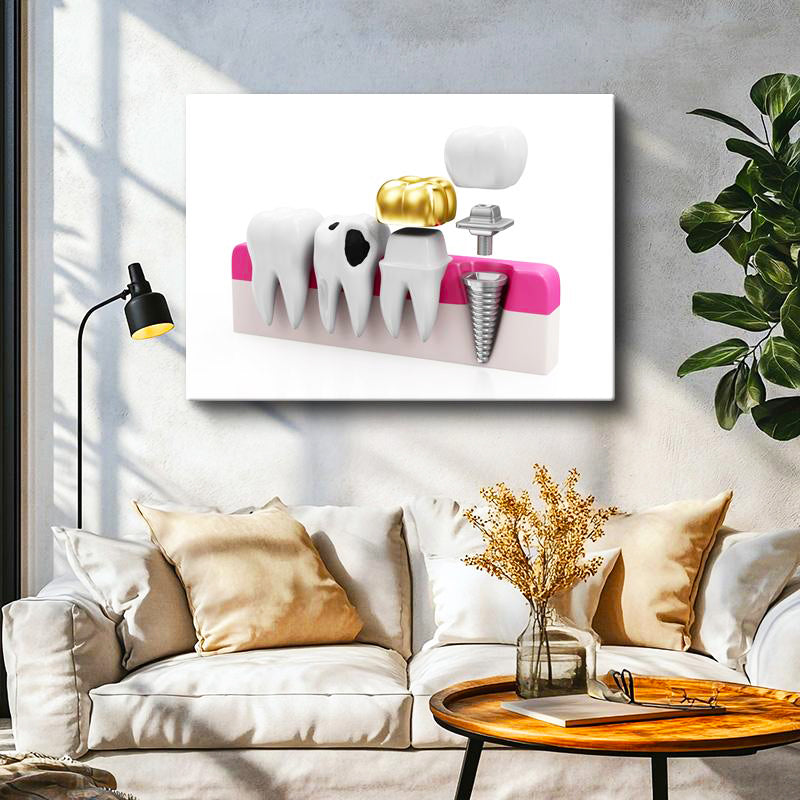 Yatay Kanvas Tablo Altın Kaplama Ve İmplant Diş Diş Hekimi Tablosu Ev Ofis Duvar Dekoru
